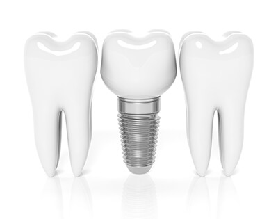 Dental Implant