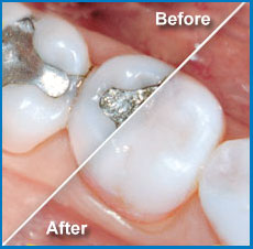 Amalgam vsComposite Fillings - Wilkinson Dental