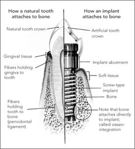Here’s What You Need to Know about Dental Implants
