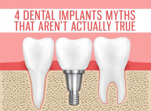 4 Dental Implants Myths That Aren’t Actually True