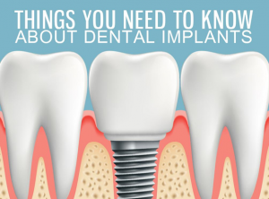 Things You Need to Know About Dental Implants