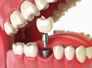 Implanting Your Smile: Q and A on Dental Implant Surgery