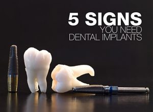 5 Signs You Need Dental Implants