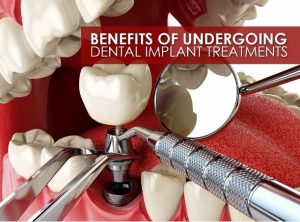 Benefits of Undergoing Dental Implant Treatments