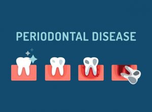The Stages of Periodontal Disease and Their Symptoms