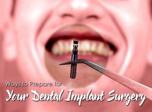 4 Ways to Prepare for Your Dental Implant Surgery